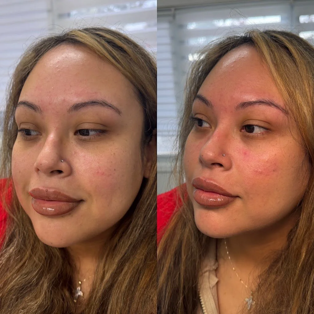 facial fillers st thomas cosmetic clinic.jpg