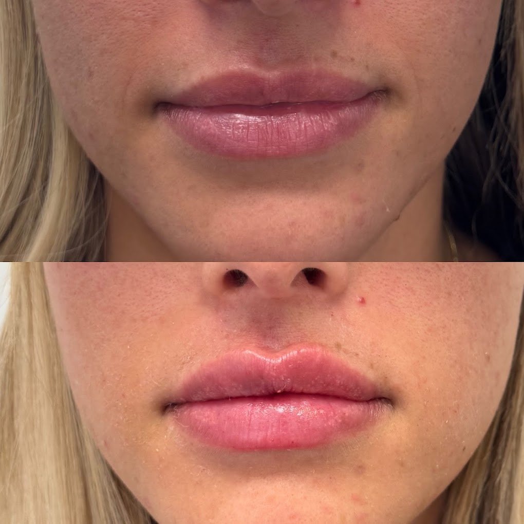 lip filler st thomas cosmetic clinic.jpg