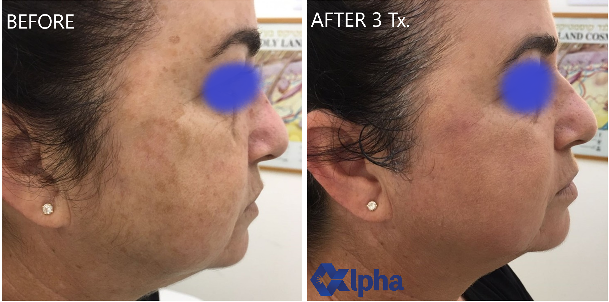 3D IPL B&A_3.png