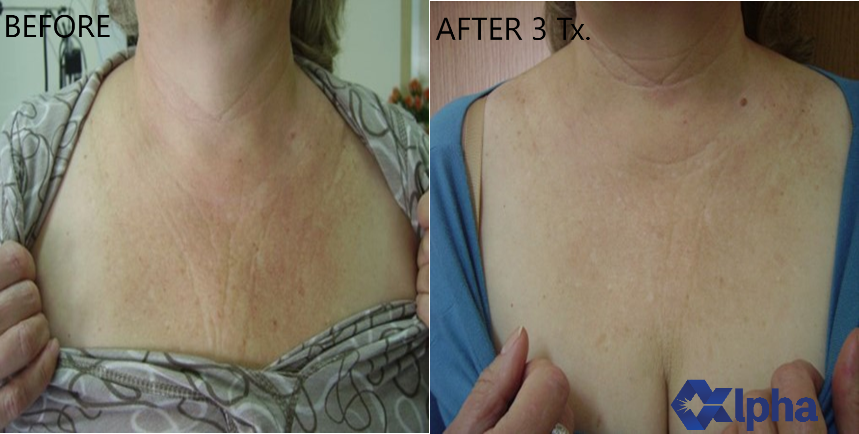 3D IPL B&A_8.png
