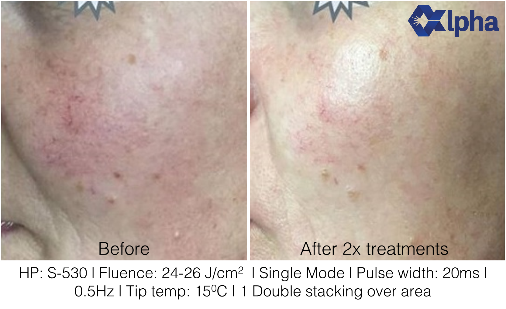 3D IPL B&A_17.png