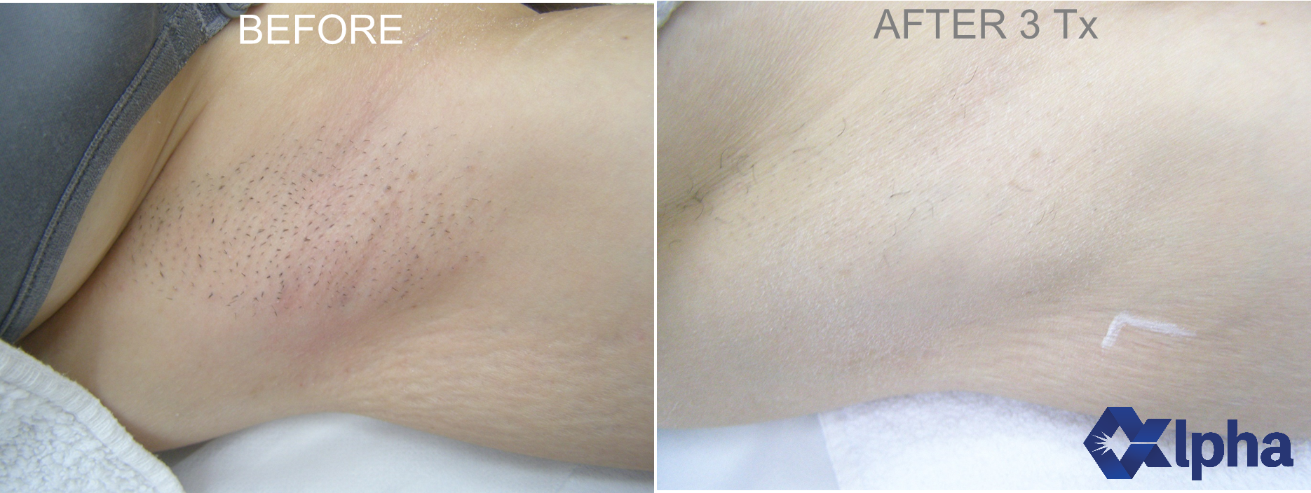 808 nm Diode Laser B&A_5.png