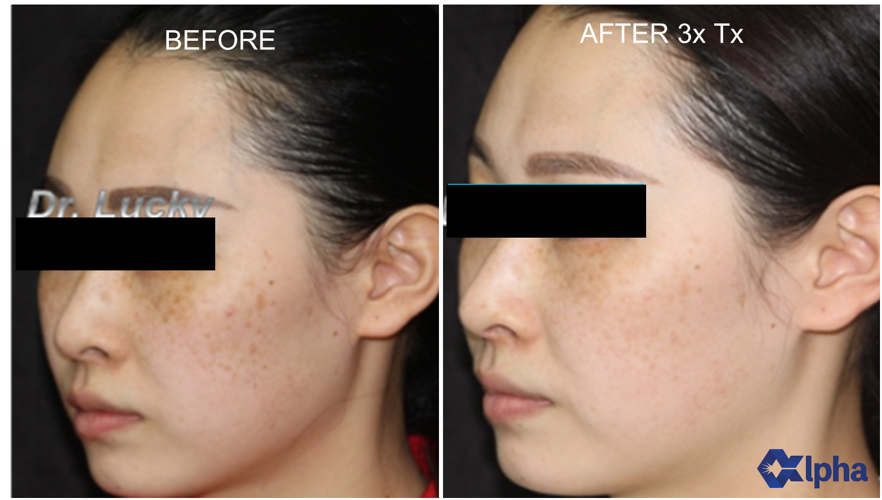 3D IPL B&A_0.png