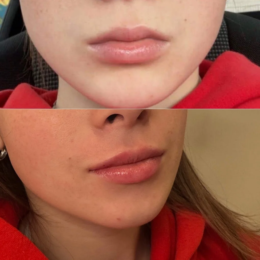 lip fillers st thomas london port stanley.jpg