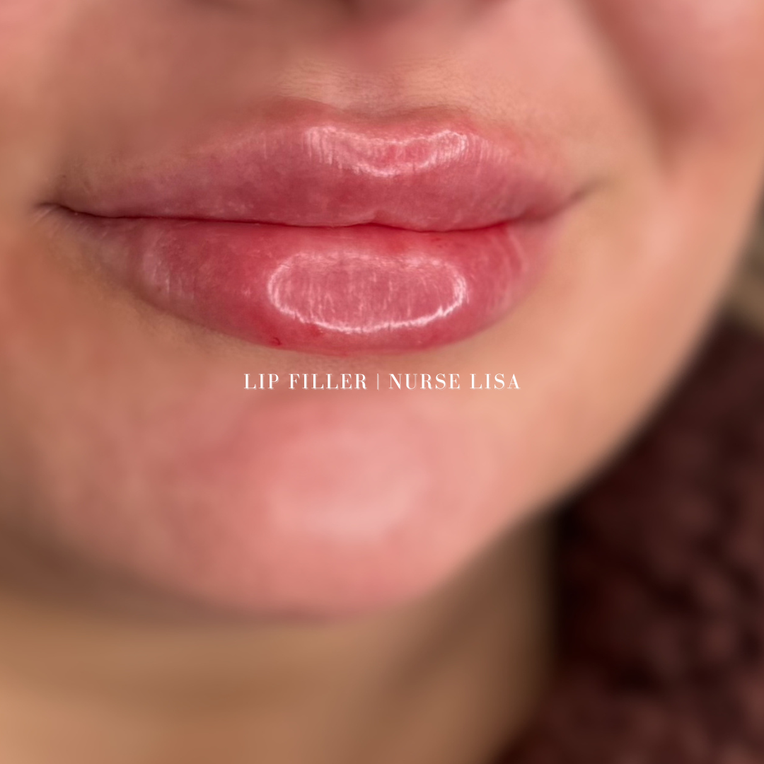 BOTOX FILLERS-62.png