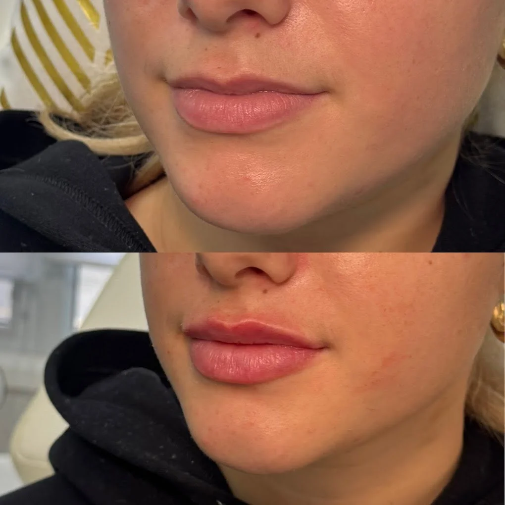 lip filler before after st thomas cosmetic clinic.jpg