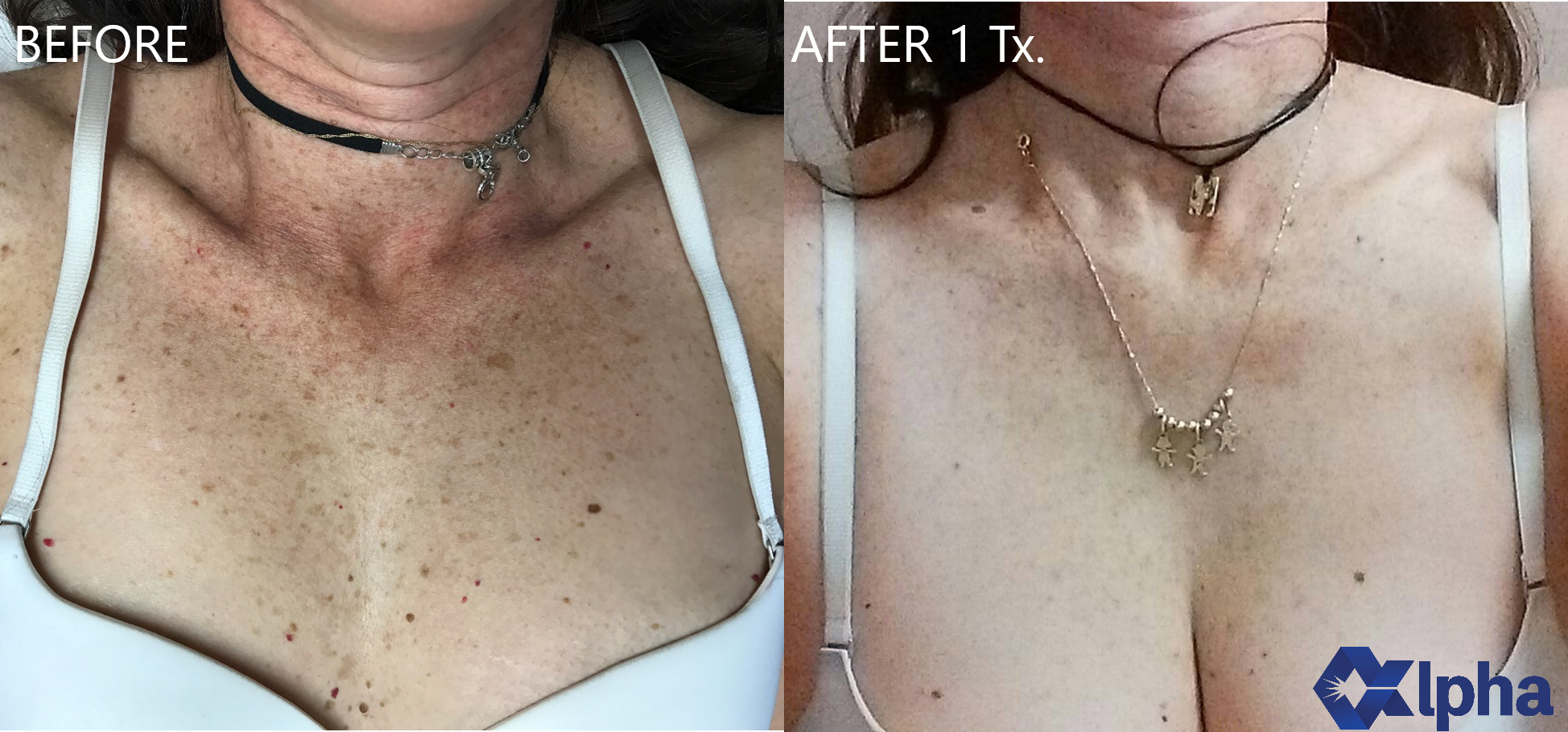 3D IPL B&A_10.png
