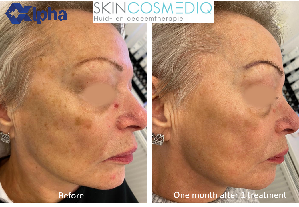 3D IPL B&A_21.png