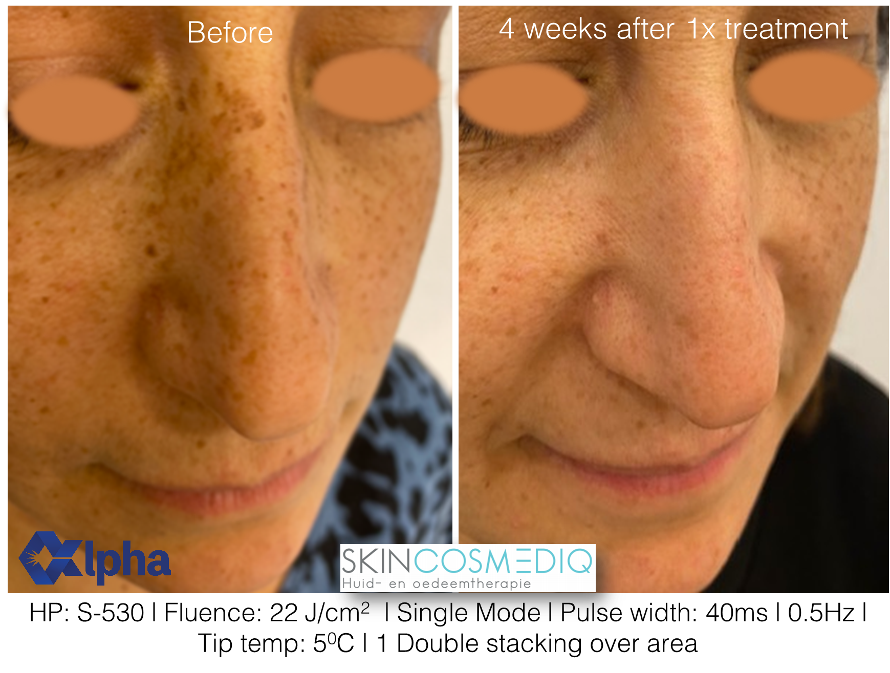 3D IPL B&A_14.png