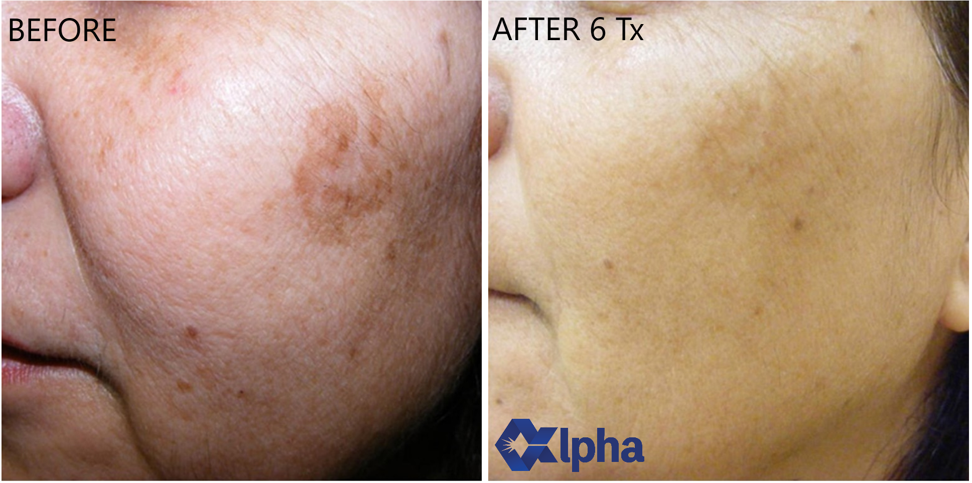 3D IPL B&A_2.png