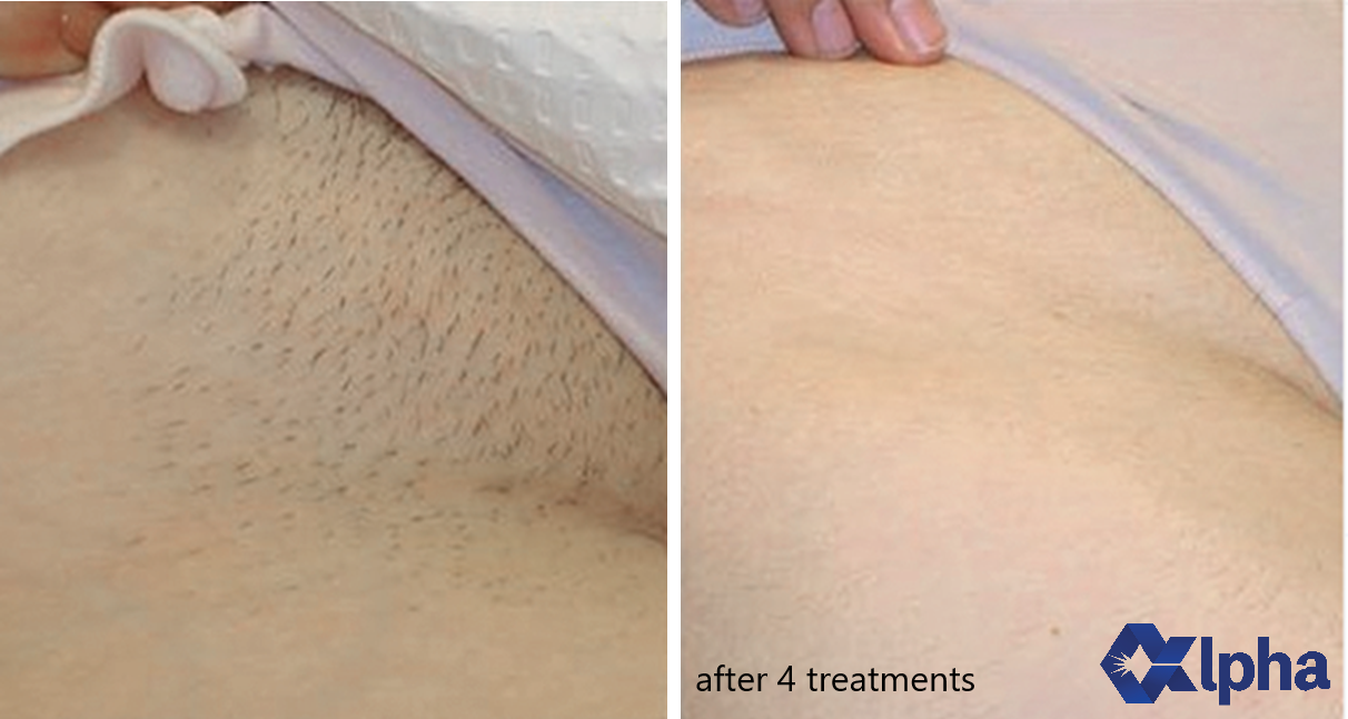 808 nm Diode Laser B&A_6.png