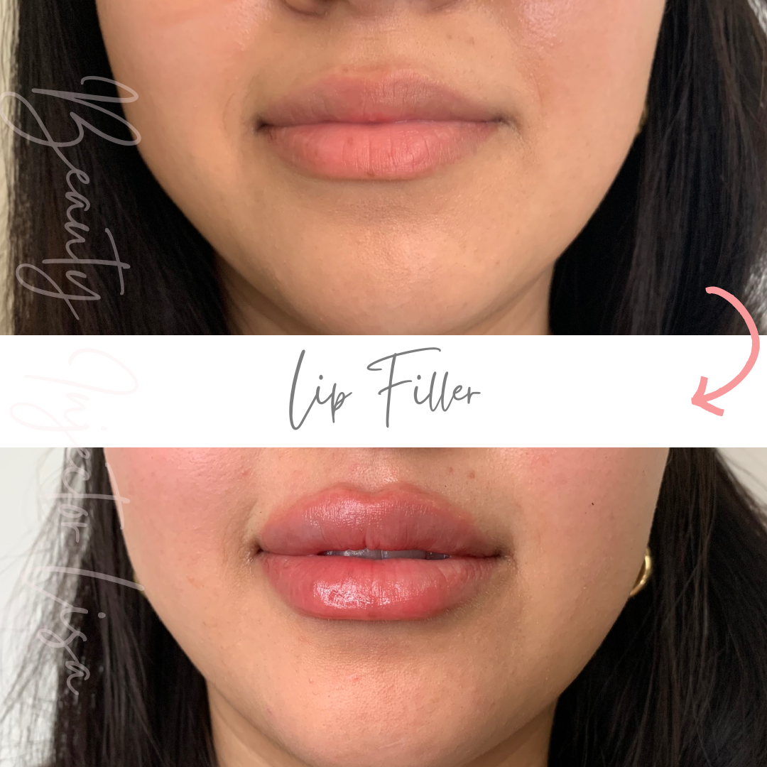 BOTOX FILLERS-18.png