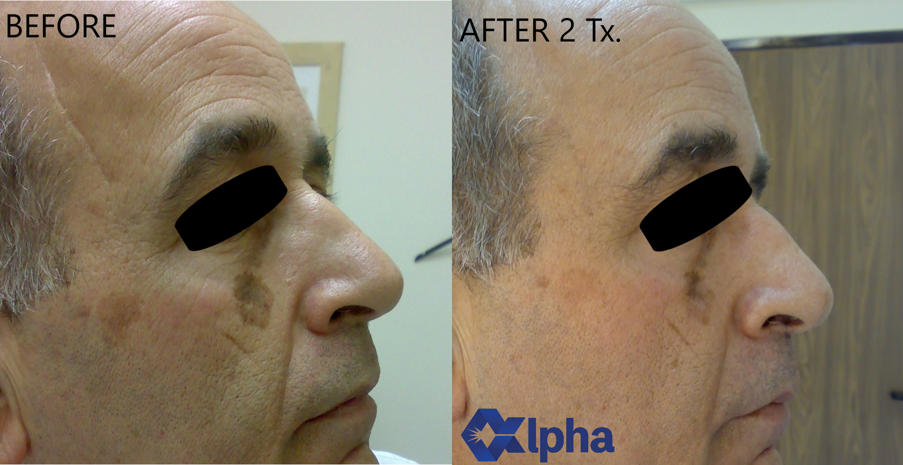 3D IPL B&A_11.png