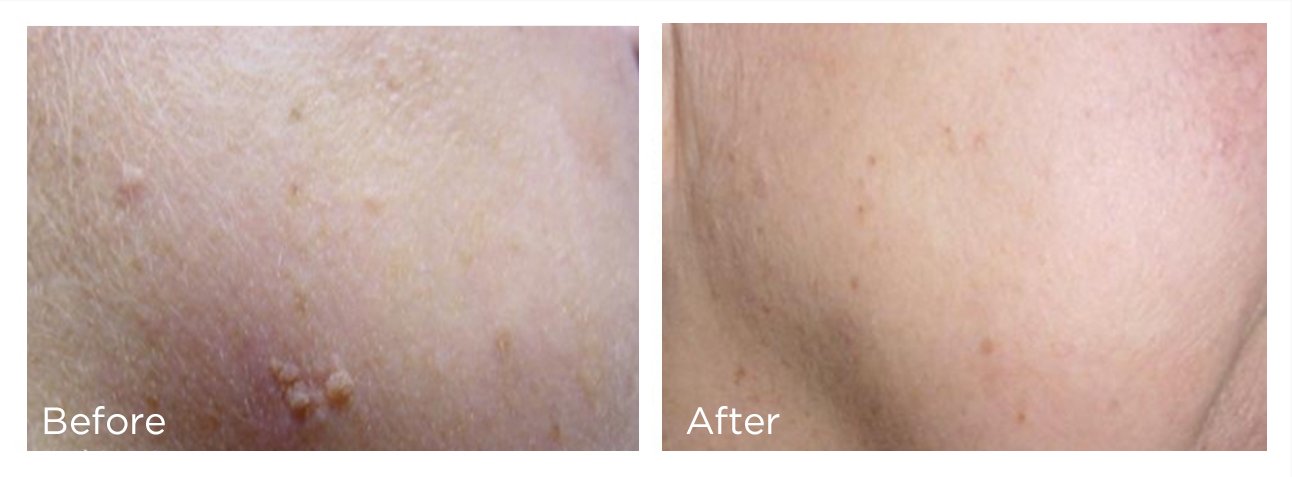 FreezePen - 7 - Print.jpg