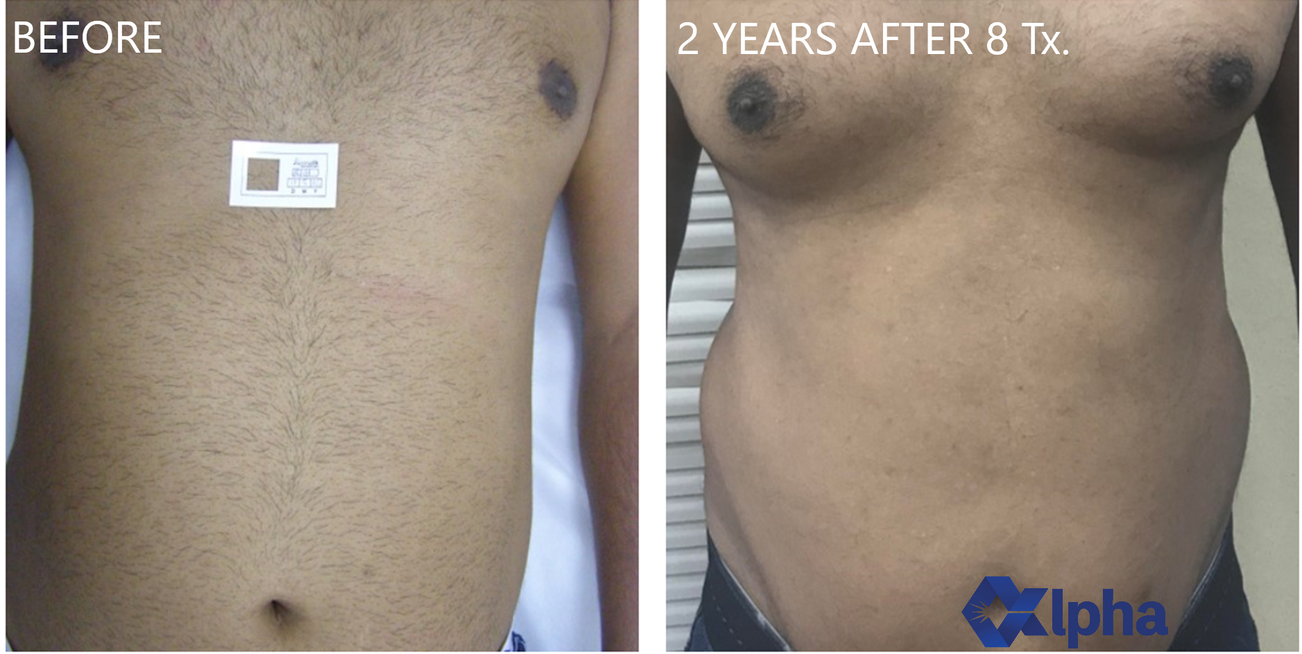 808 nm Diode Laser B&A_1.png