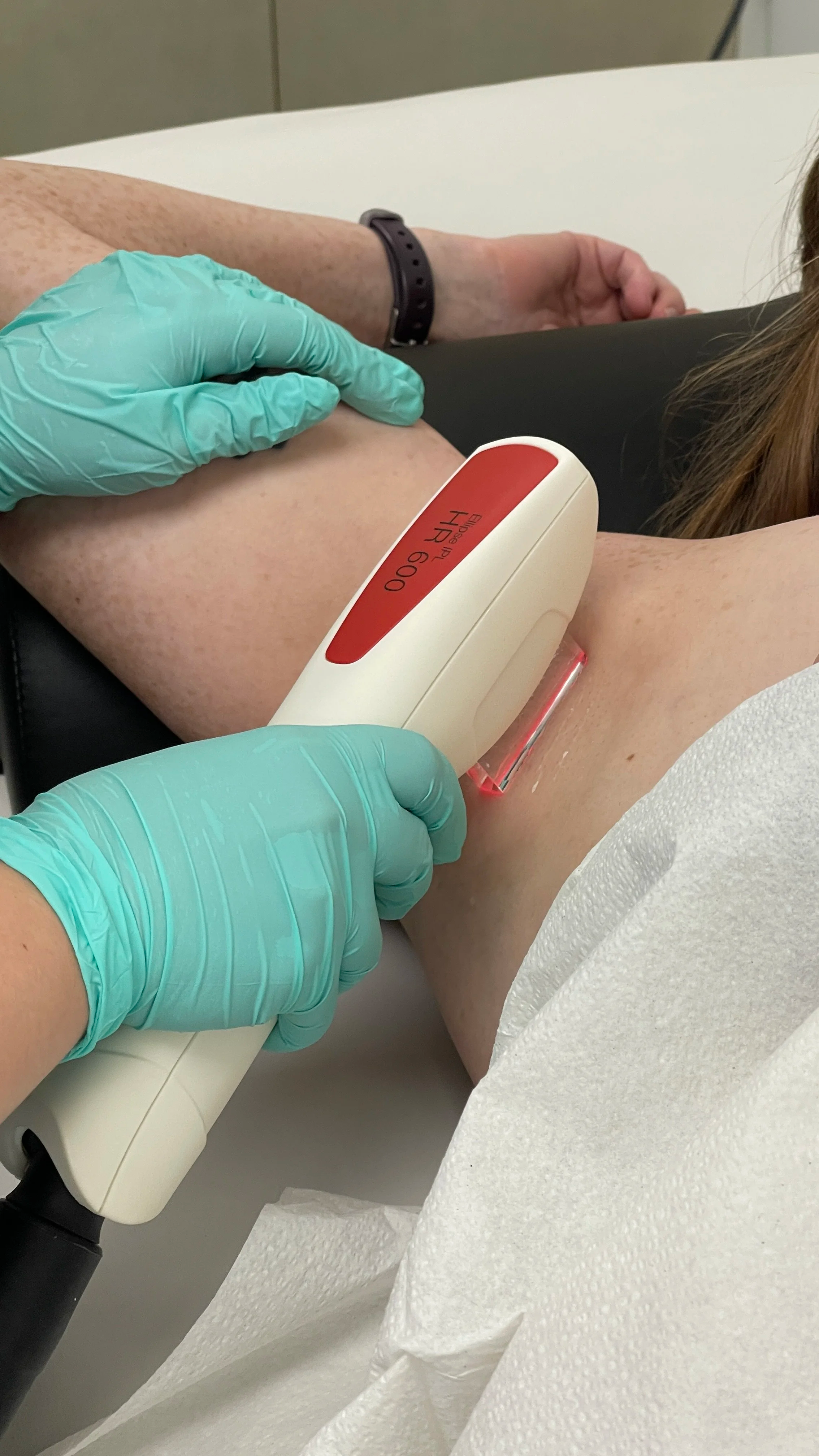 A person receiving  IPL hair removal treatment on their upper arm in a medical setting, with healthcare professional wearing light blue gloves holding a device labeled 'Eloise HR 600' near the patient's arm. 