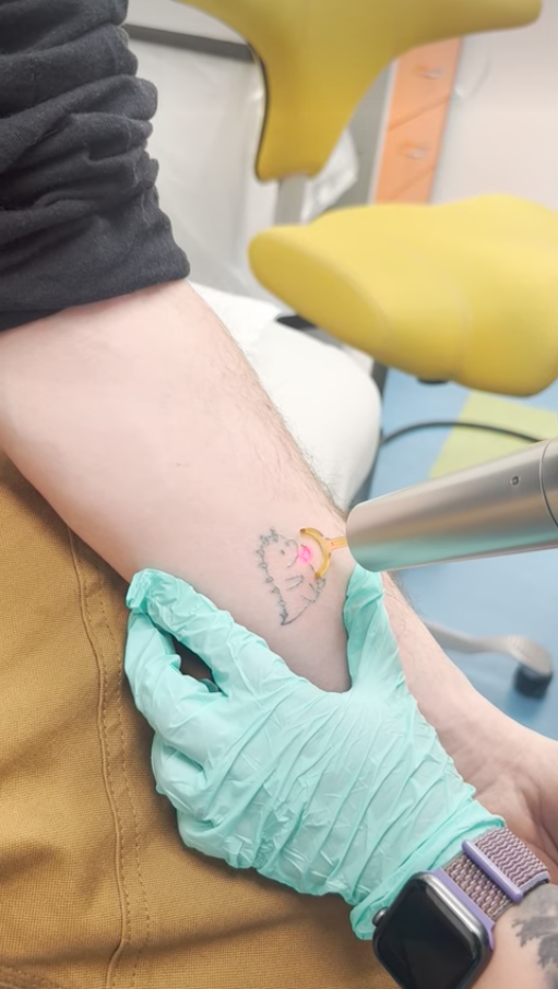 Laser tattoo removal on male forearm of a tiny dinosaur