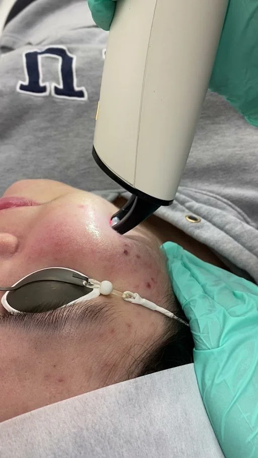 Client receiving an acne scar facial resurfacing and rejuvenation treatment using the from the Frax 1550 device.