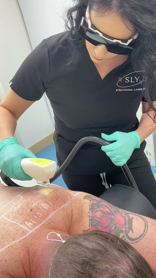 Freckle / lentigne removal using Nordlys