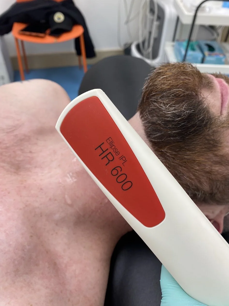 Treatment provider providing IPL hair removal on a male neck in a clinic setting using a Nordlys HR600 handset.