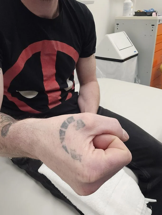 Client showing results after first session of laser tattoo removal on left hand