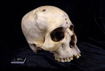 Ancient skull with brain cancer preserves clues to Egyptian medicine Spring 2024