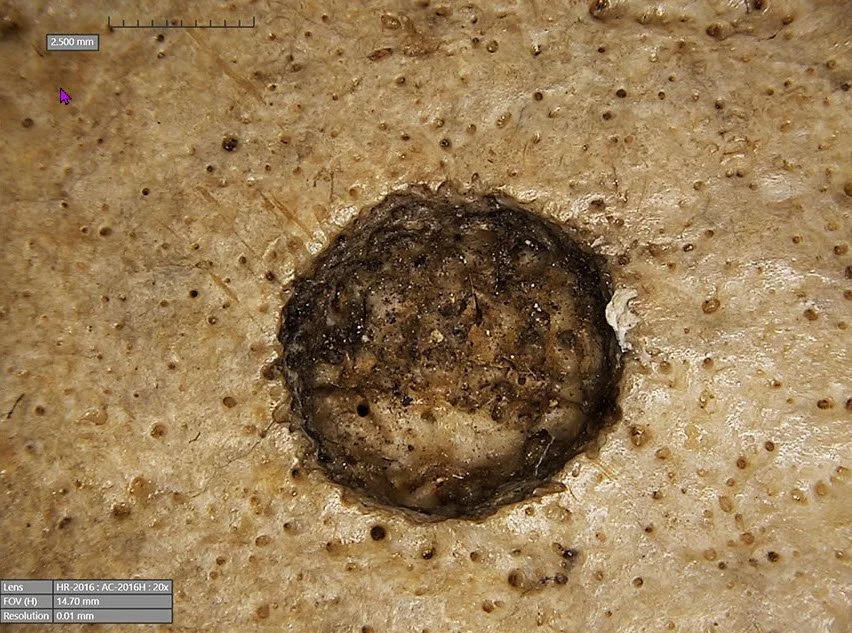 Brain Cancer is a 4600 Year Old Skull - Summer 2024