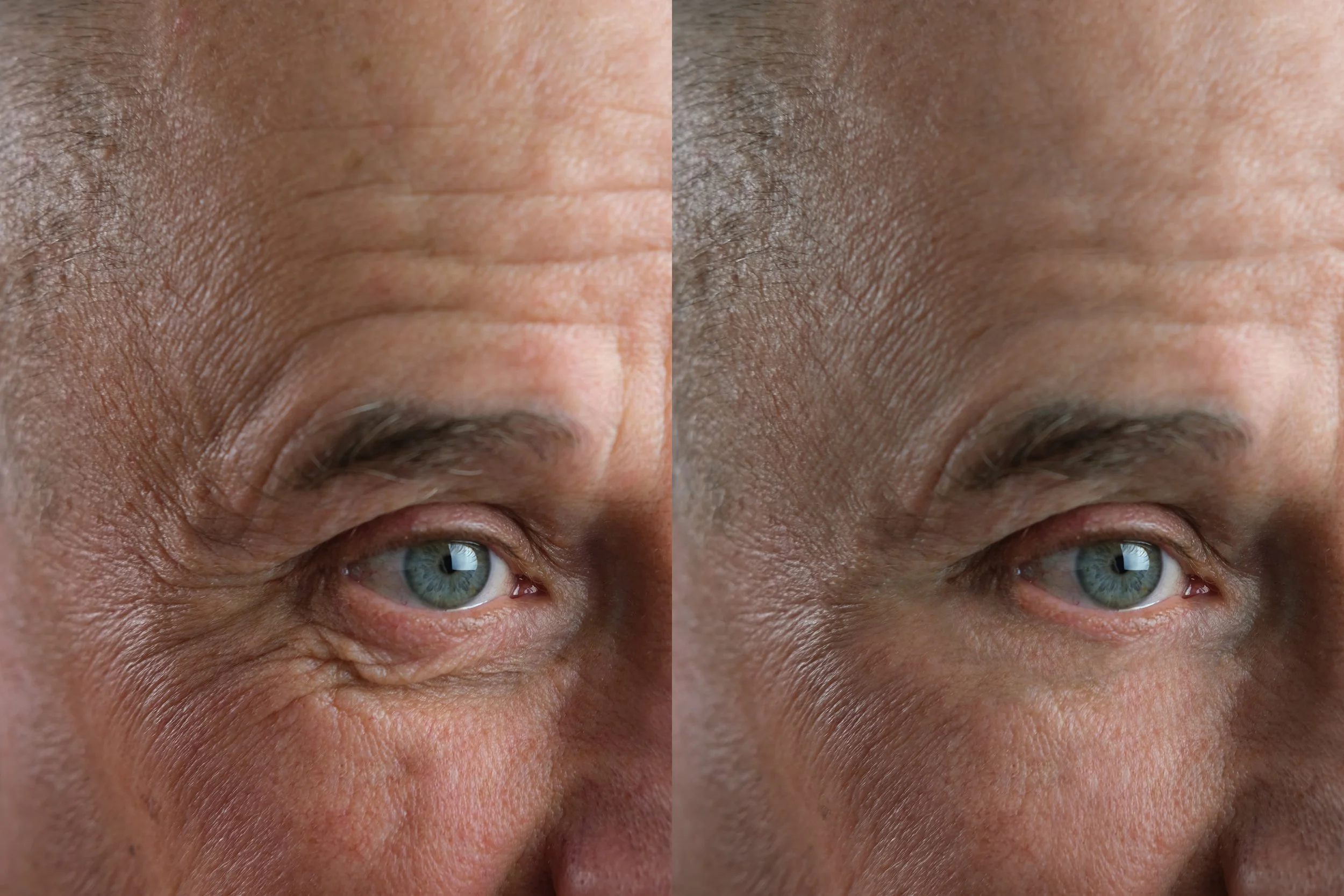 Close-up of a person's face showing a before and after comparison of skin appearance, focusing on the eye and forehead areas.