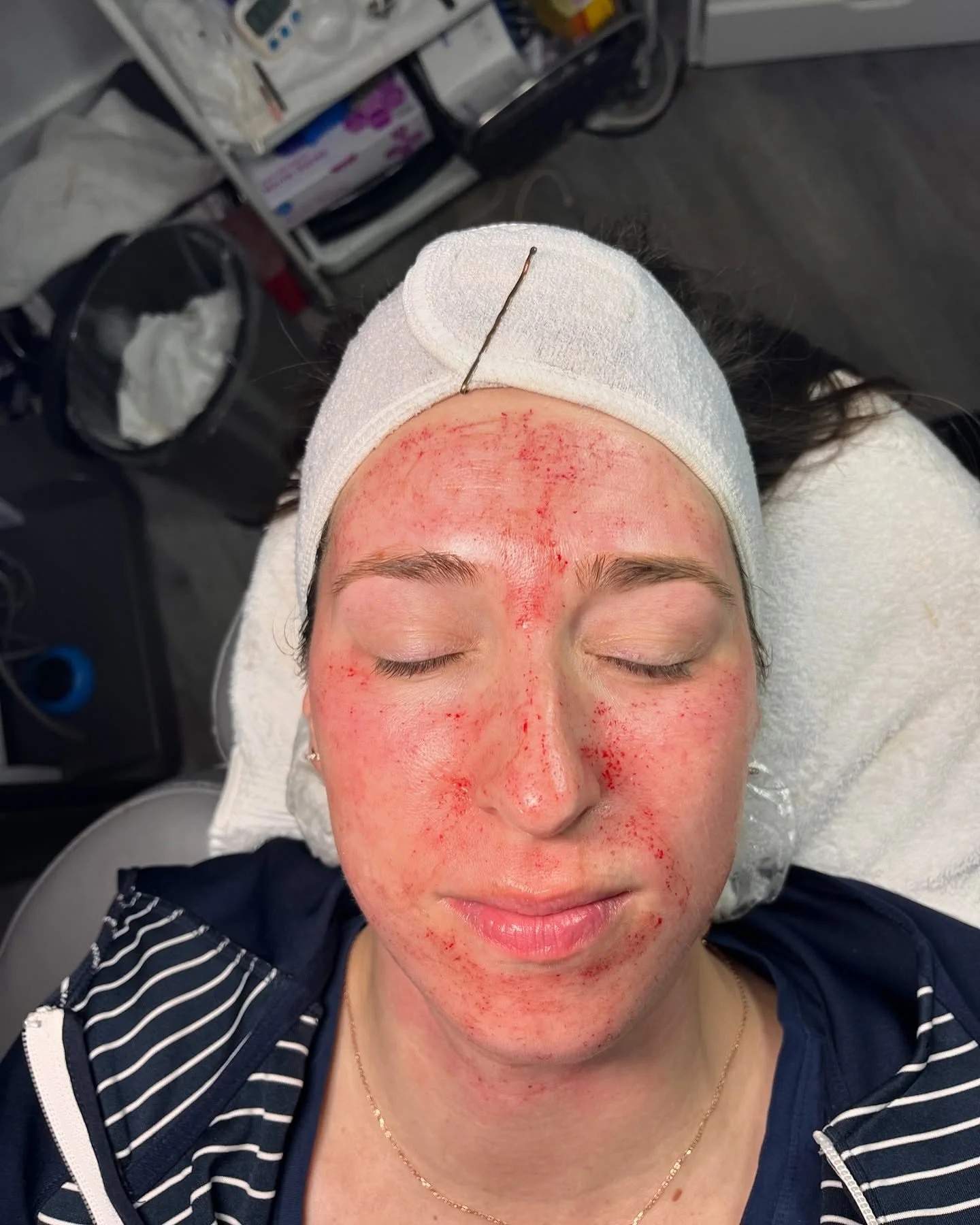 After a full skinpen treatment! We promise it&rsquo;s worth it for the collagen production, reducing fine lines and wrinkles, and minimizing acne scarring. 

Reach out to get scheduled for your consultation!!