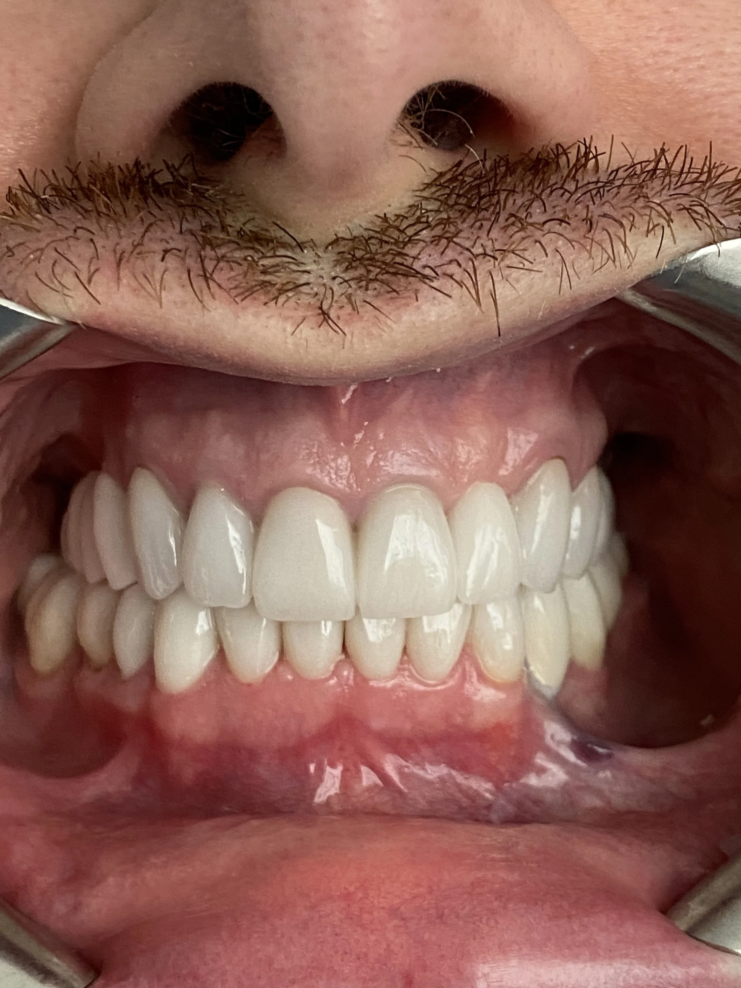 Implanturi dentare și reabilitare orală completă cu coroane integral ceramice și bonturi hibride de
