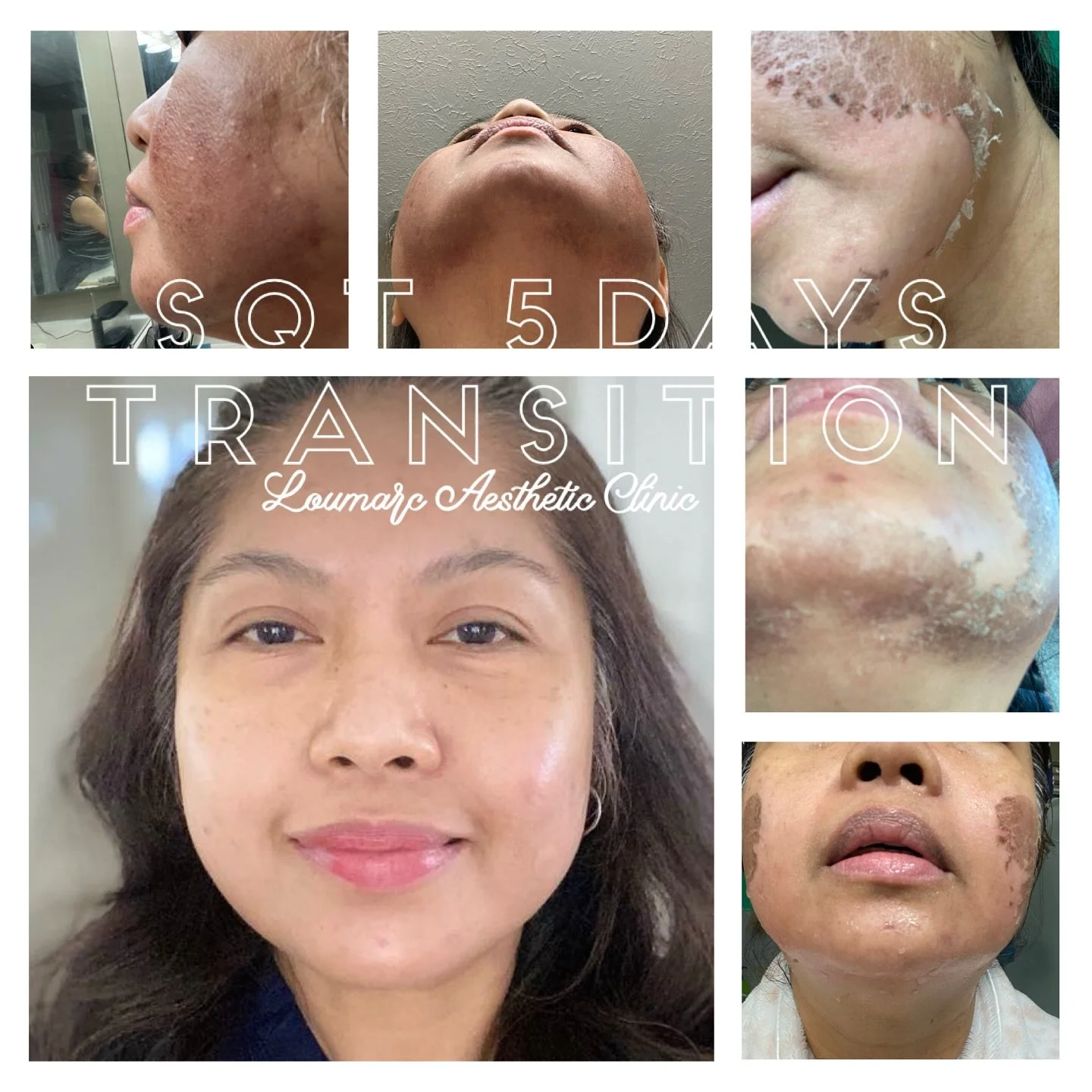 A collage showing before and after images of a woman undergoing skin treatment over five days at Loumarc Aesthetic Clinic, including close-ups of facial skin improvements.