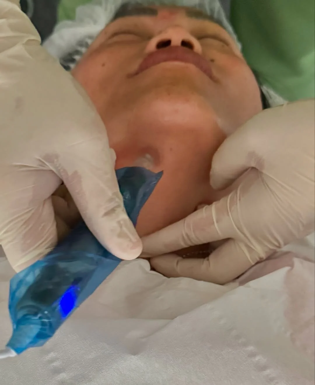 Close-up of a medical procedure on a person's neck, with gloved hands holding a medical device near the person's skin.