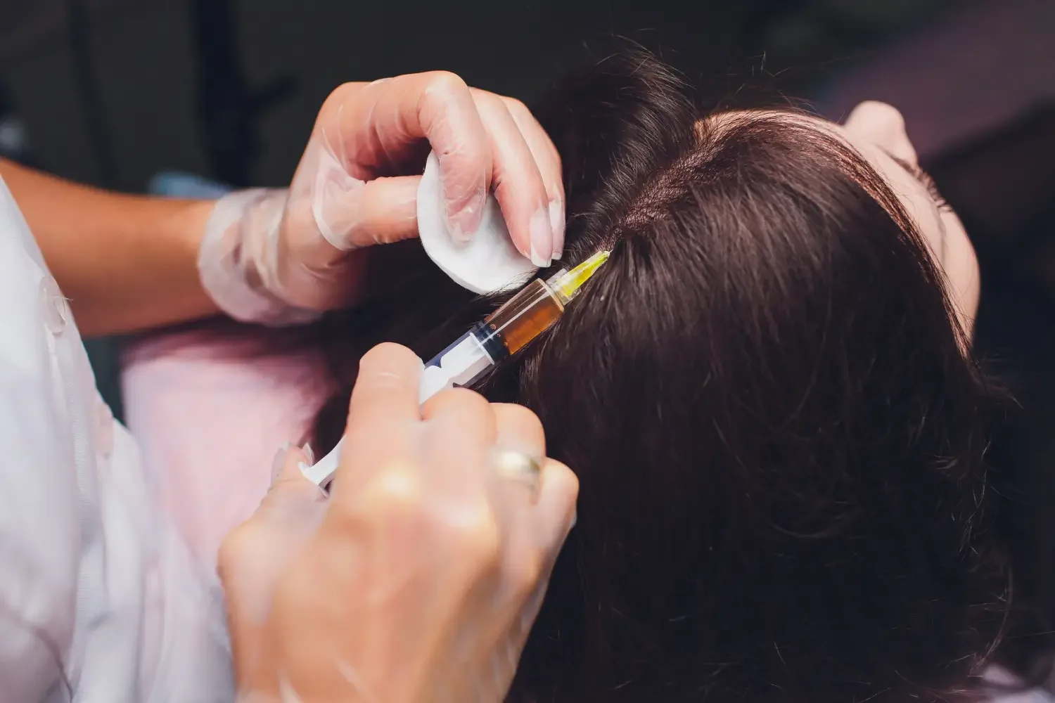 A medical professional administering a hair treatment injection into a person's scalp using a syringe, while holding a cotton pad.