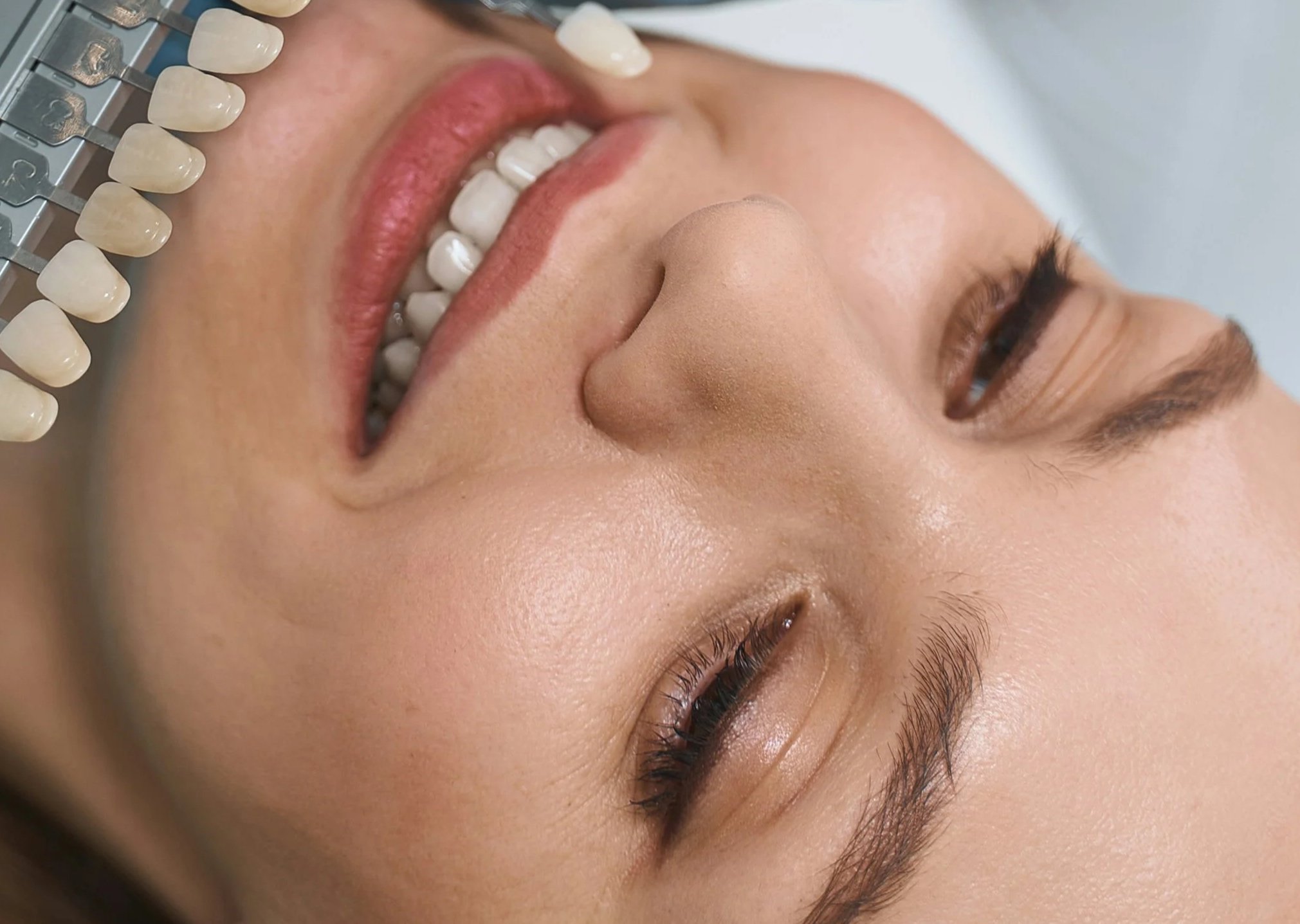 Vollkeramische Veneers