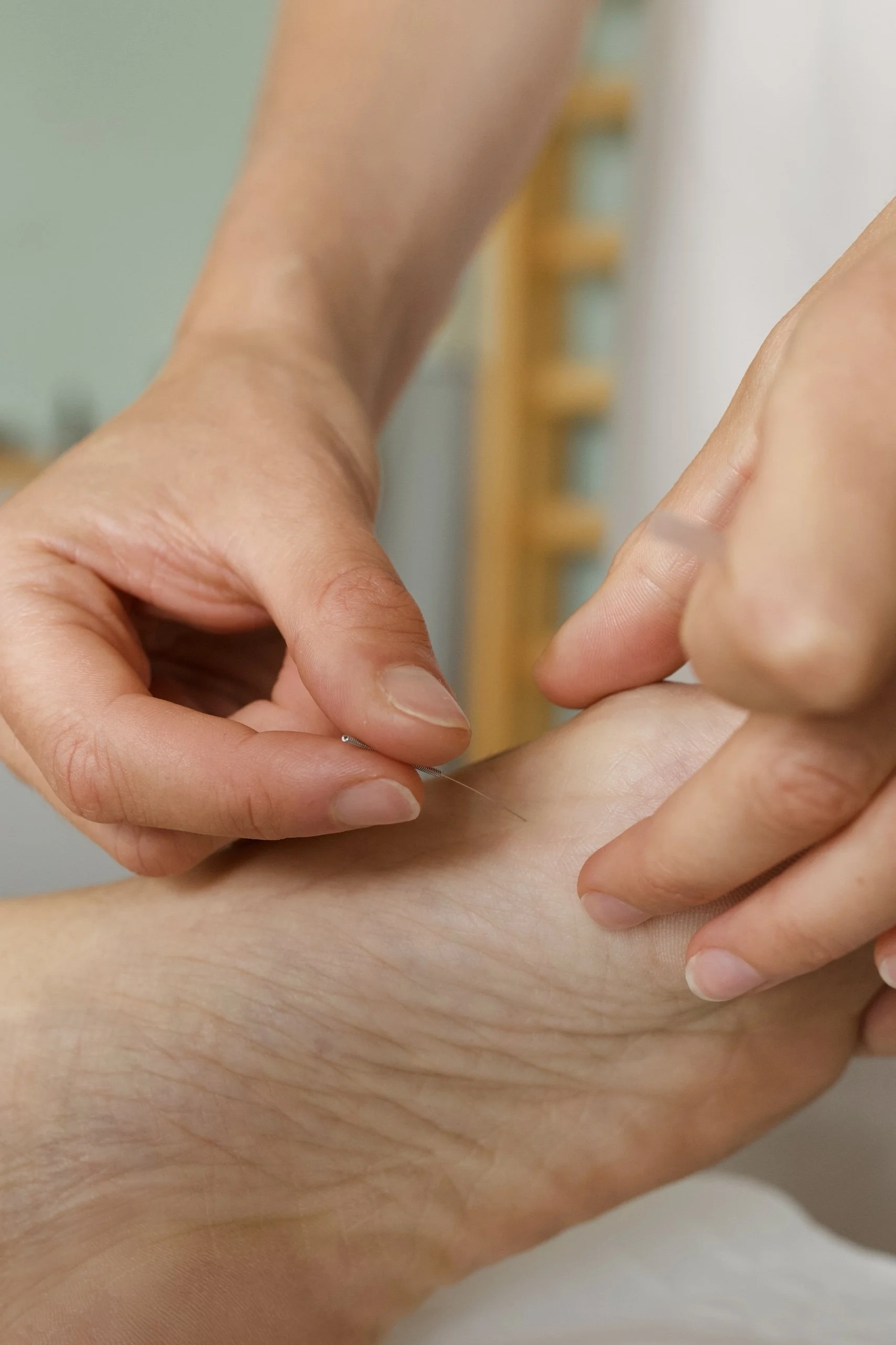 Person's hand receiving acupuncture treatment, with thin acupuncture needle being inserted into the wrist area.
