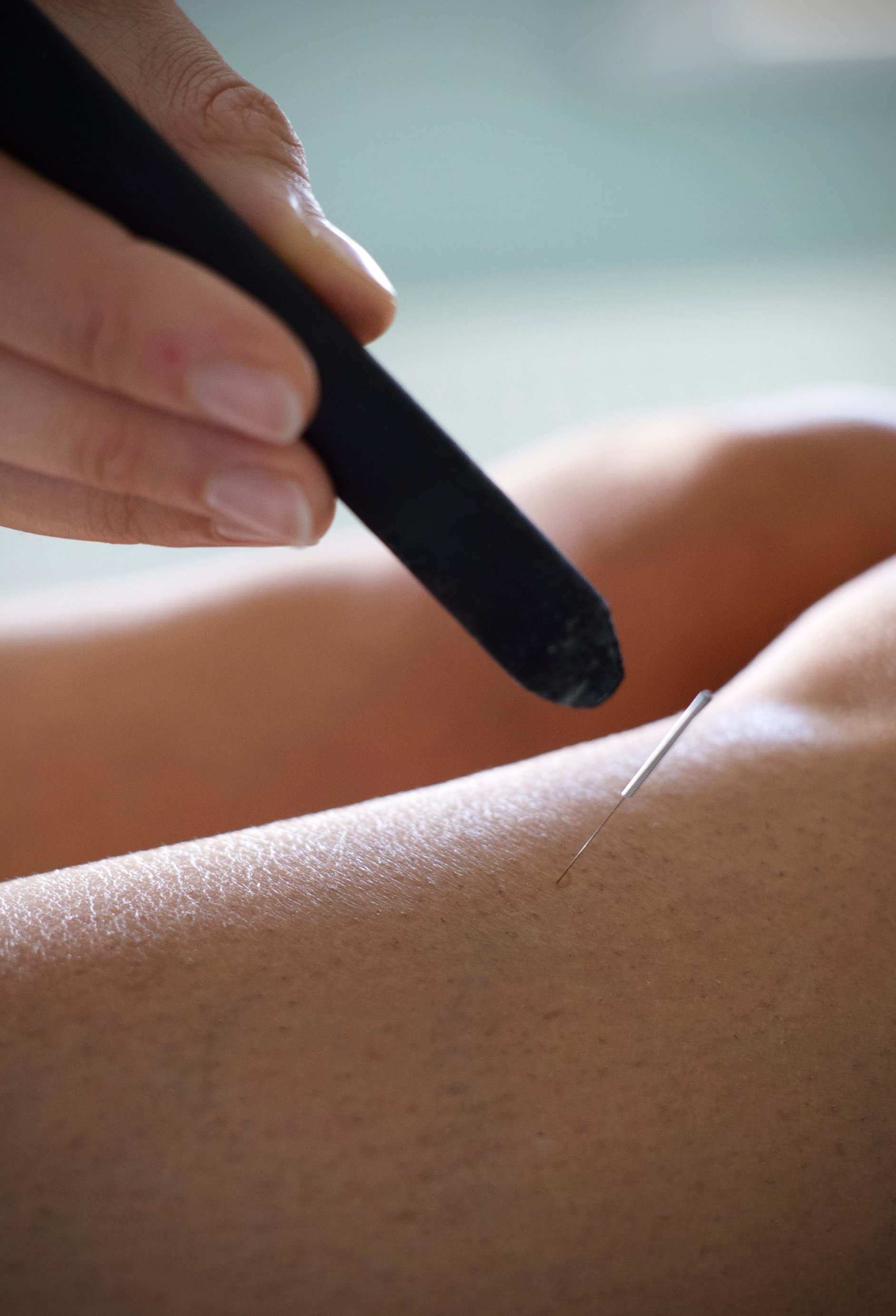 Close-up of a person's back receiving acupuncture, with a thin needle being inserted.