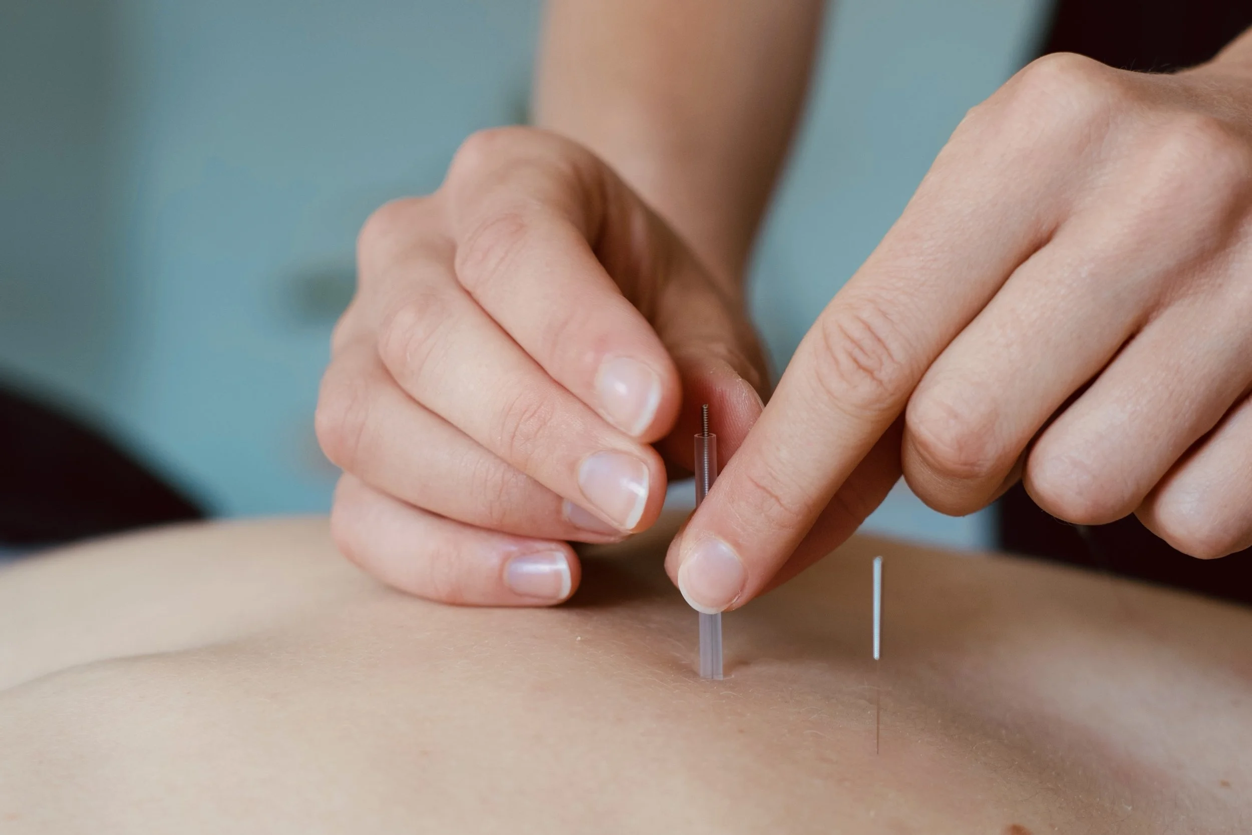 A person receiving acupuncture treatment, with thin needles inserted into their skin on their back.
