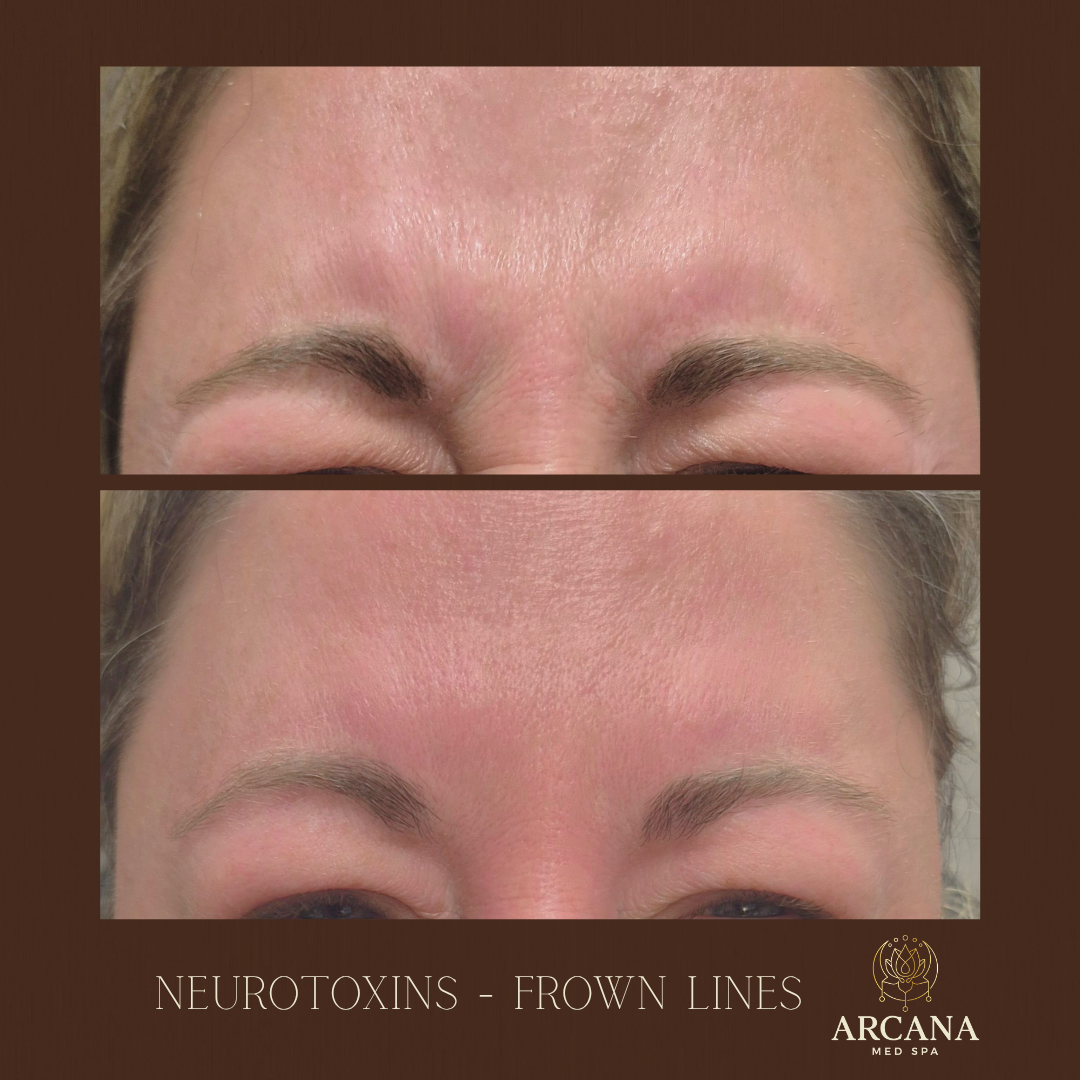 botox-frown-lines-arcana-med-spa-castle-rock.png