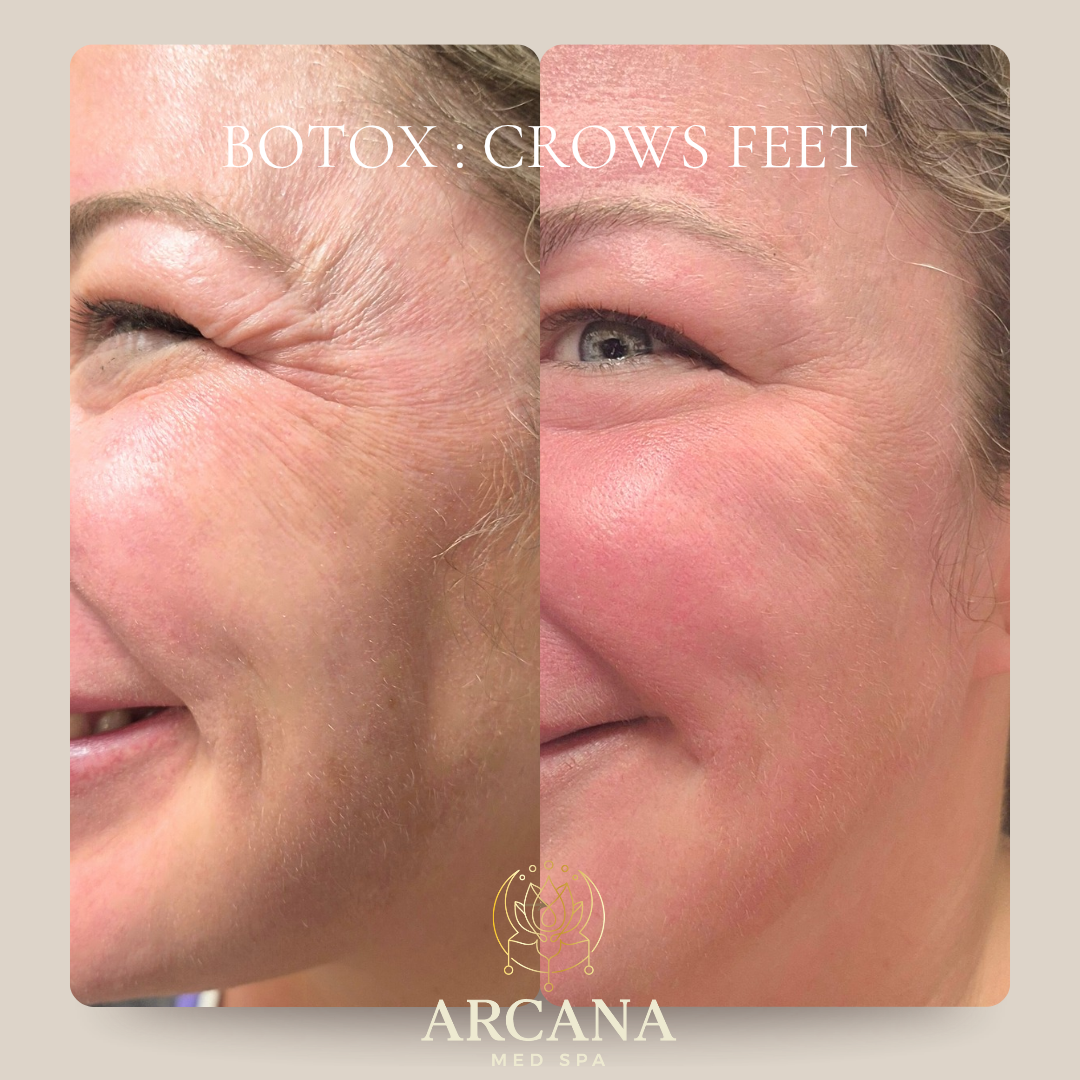 Botox before after Arcana Med Spa Castle Rock.png