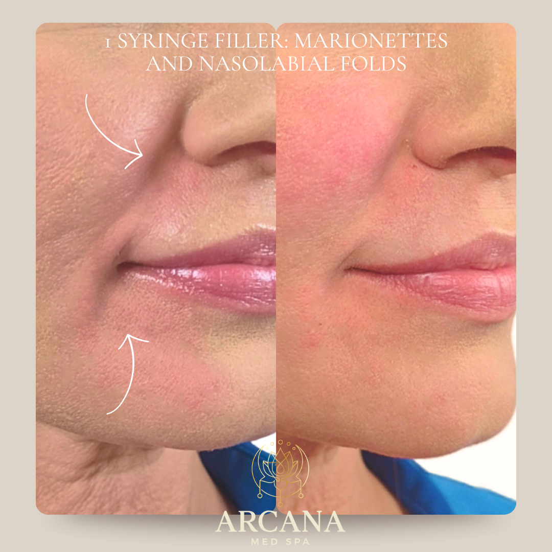 Dermal Filler marionettes before after Arcana Med Spa Castle Rock.png