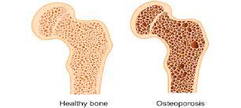 “If You’ve Been Told You Have Osteoporosis, Start Here”
