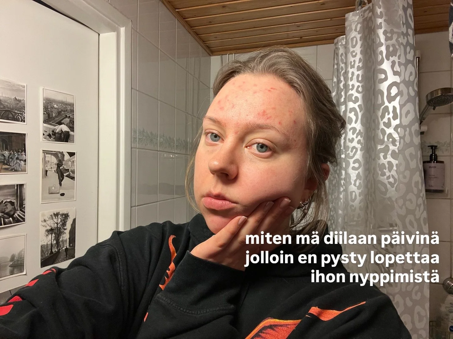ur local nyppimis-rep reporting for duty! 💌 toiset p&auml;iv&auml;t on vaikeempii ku toiset, mut muista ett&auml; sun arvo ei riipu niist&auml; ⚡️ #dermatillomania #ihonhoito #iho #mielenterveys