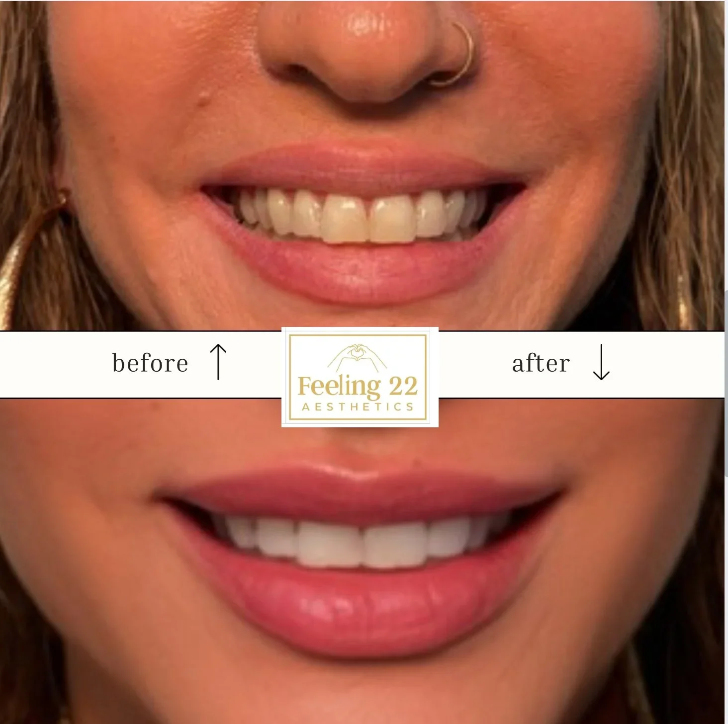 Comparison of a woman's smile before and after teeth whitening at Feeling 22 Aesthetics, showing brighter teeth in the after photo.