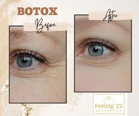 Comparison of a person's eye before and after Botox treatment, showing reduced wrinkles around the eye.