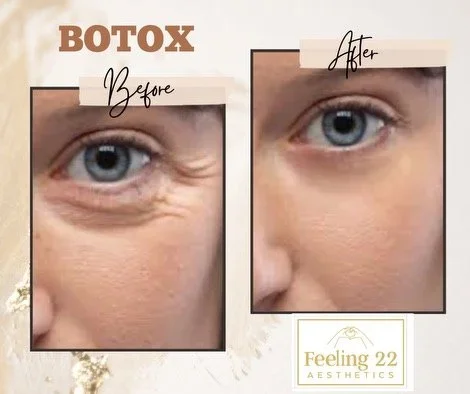 Side-by-side comparison of a woman's face before and after Botox treatment, showing reduced wrinkles around the eye.