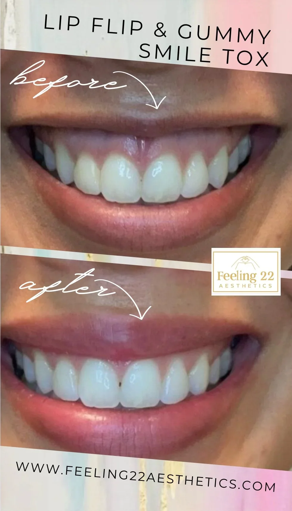 Before and after images of a person's smile showing the effects of lip flip and gummy smile Botox treatment, with the before image displaying a gummy smile and the after image showing a more relaxed smile.