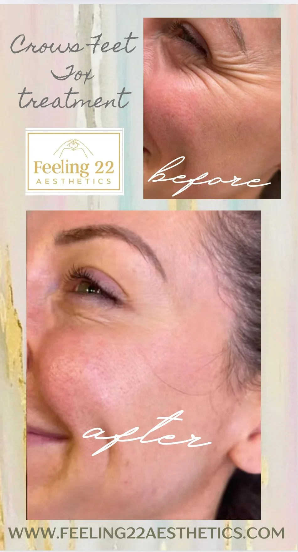 Before and after images of a woman's crow's feet treatment by Feeling 22 Aesthetics, showing reduction of wrinkles around the eyes.