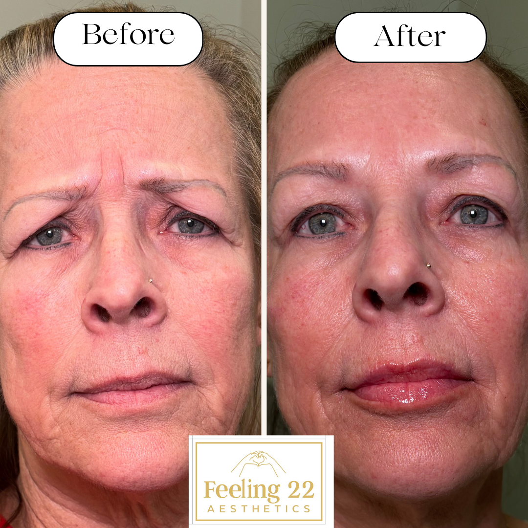 Before and after images of a woman who has undergone a cosmetic treatment, showing reduced wrinkles, smoother skin, and a more youthful appearance.