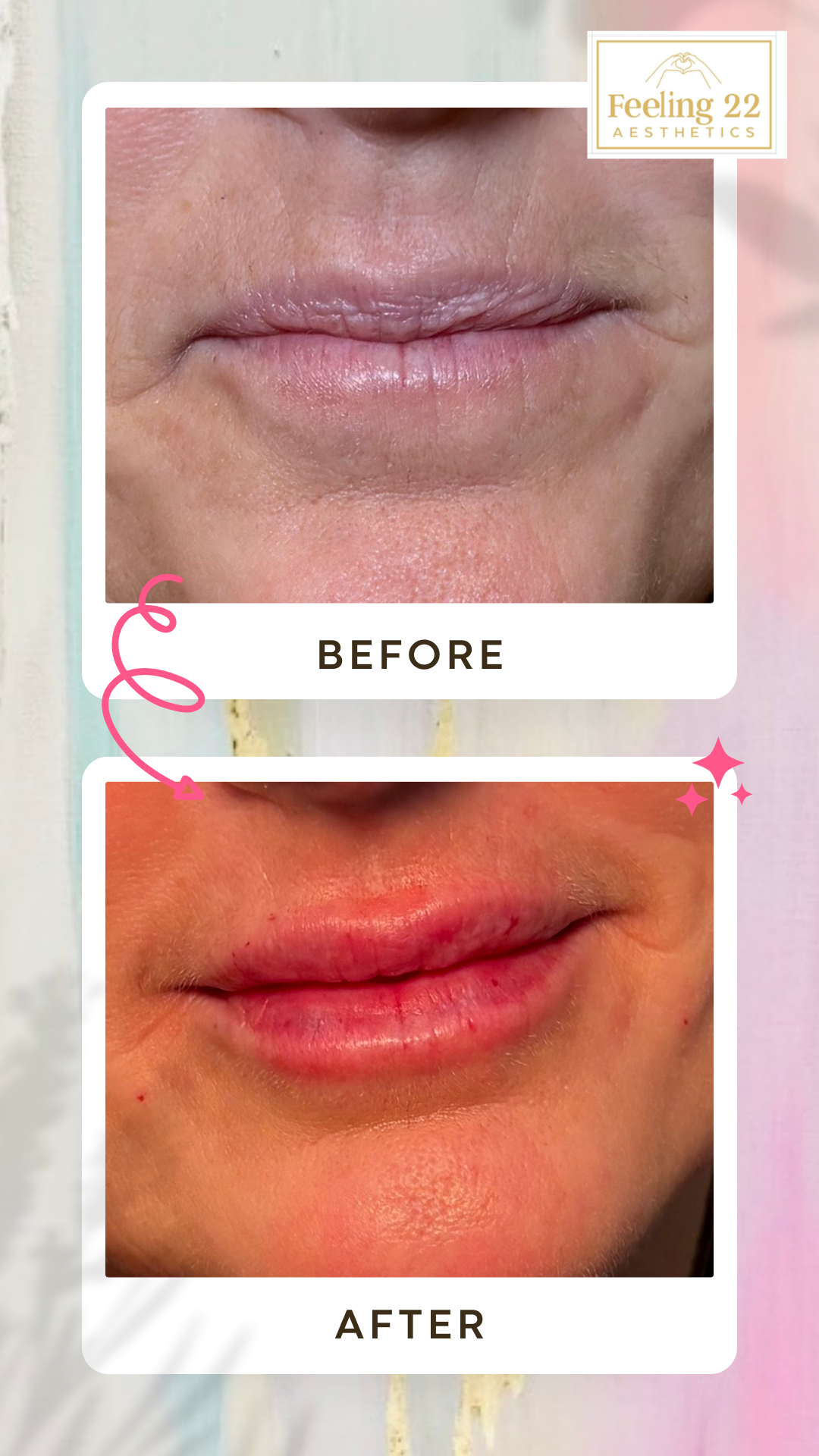 Close-up of a person's lips showing a before and after comparison of lip treatment. The before image displays dry, slightly chapped lips, while the after image shows smoother, more hydrated lips with minor redness and visible irritation.