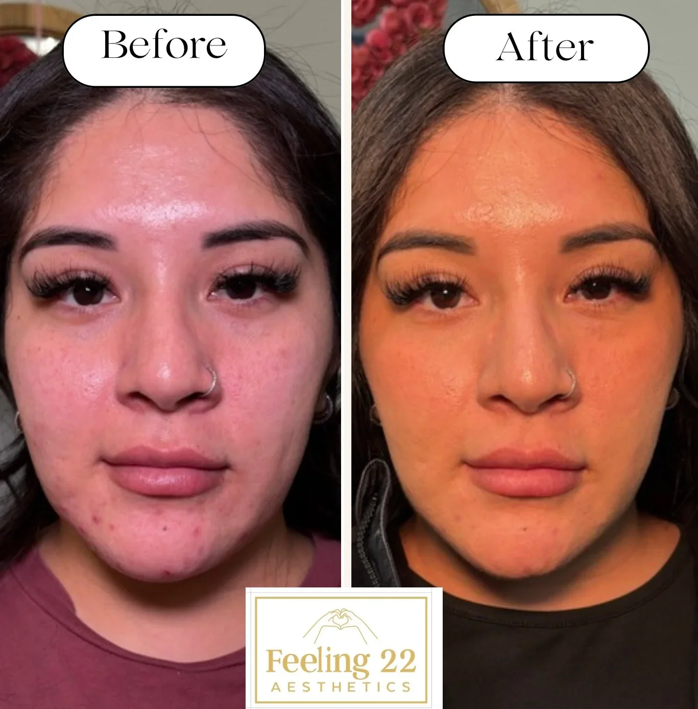 Before and after side-by-side photos of a woman with clear skin, showing a reduction in acne and redness after skincare treatment, with the logo for Feeling 22 Aesthetics at the bottom.